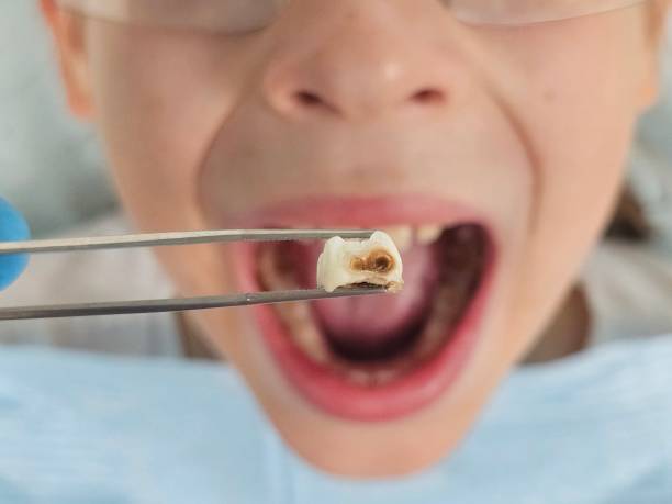 Best Emergency Dental Care for Sports Injuries in Benbrook, TX